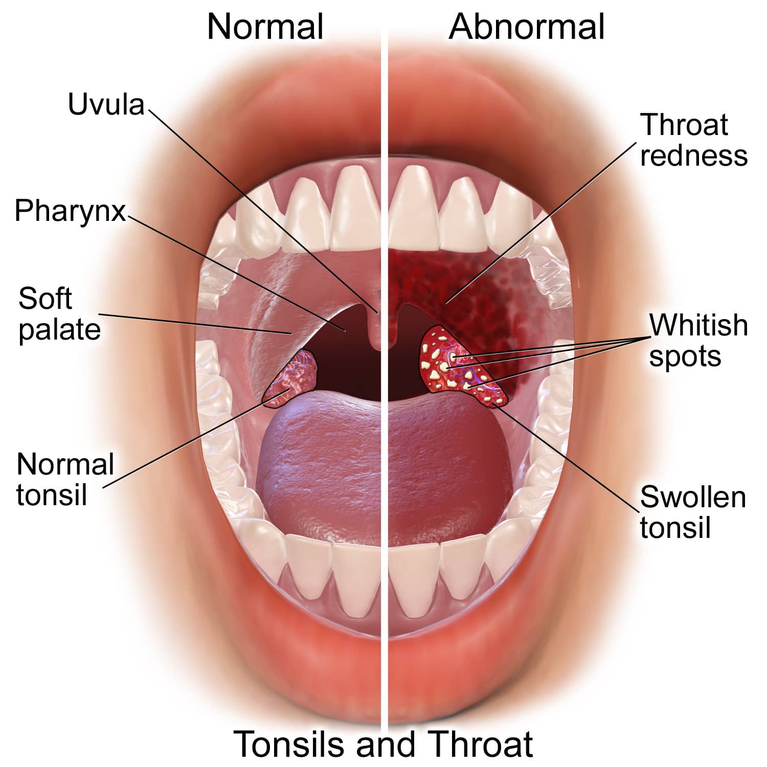 Strep-Throat-Symptoms-Things
