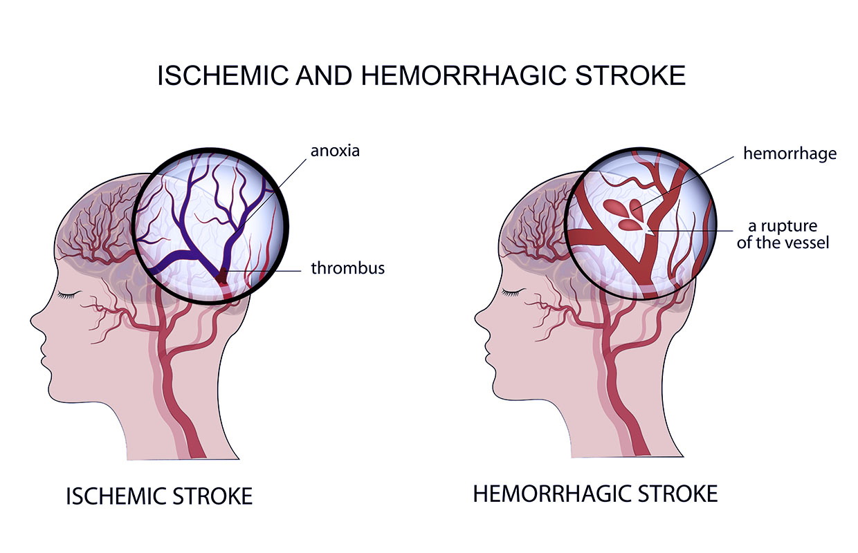 types-of-stroke