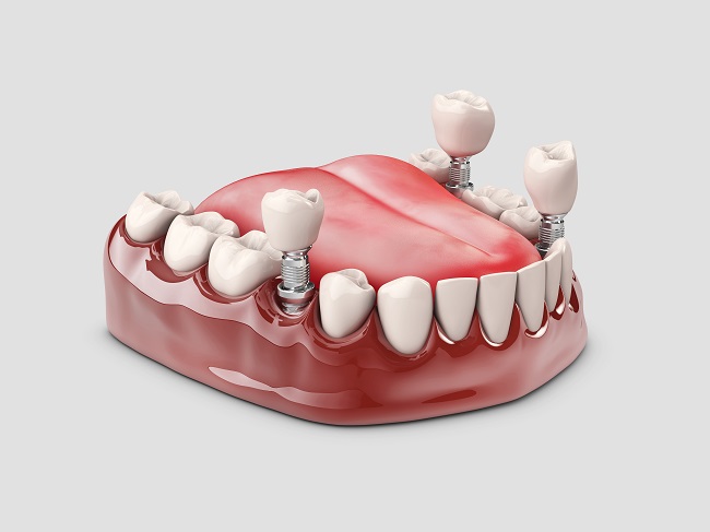 Human,Teeth,And,Dental,Implant.,3d,Illustration