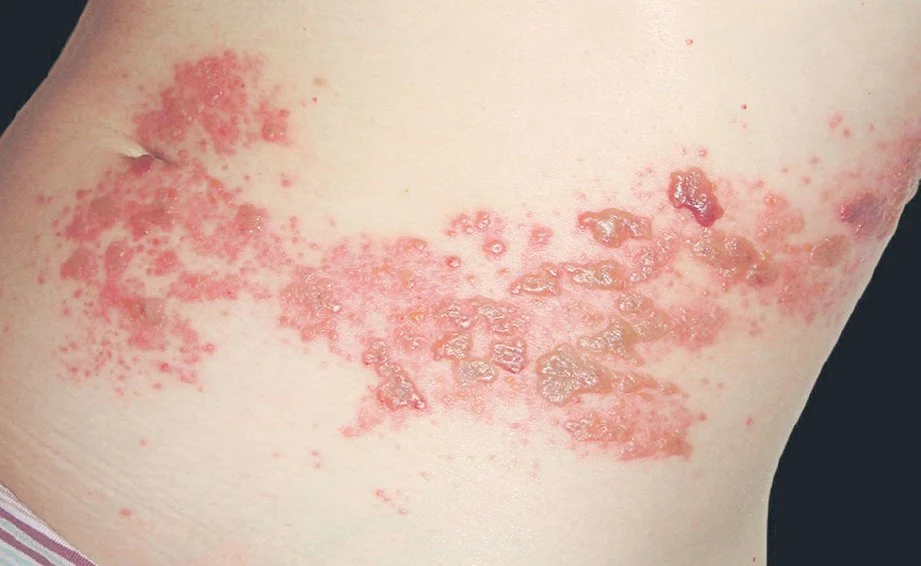 virus1