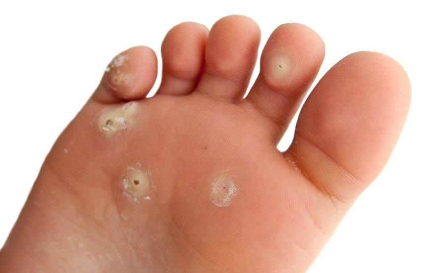 warts-leg