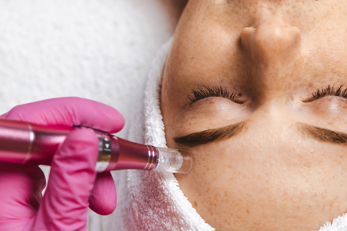 dermapen-microneedling-closeup-light-skin