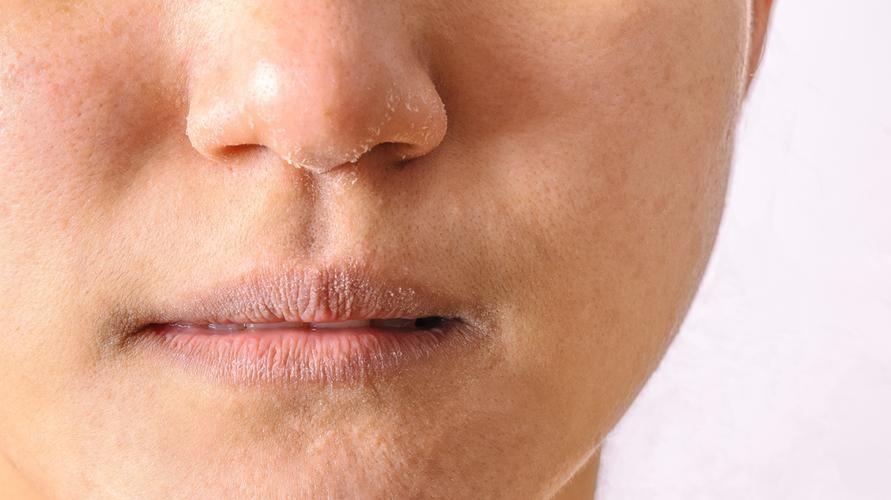 kulit-muka-mengelupas-dan-cara-mengatasinya-agar-mulus-kembali-1603349338