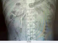 SAKIT PERUT SEBAB PERNAH TERTELAN TERMOMETER 20 TAHUN LALU