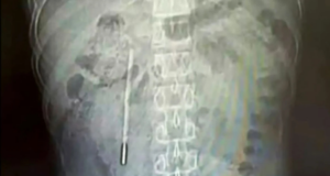 SAKIT PERUT SEBAB PERNAH TERTELAN TERMOMETER 20 TAHUN LALU