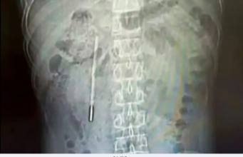 SAKIT PERUT SEBAB PERNAH TERTELAN TERMOMETER 20 TAHUN LALU